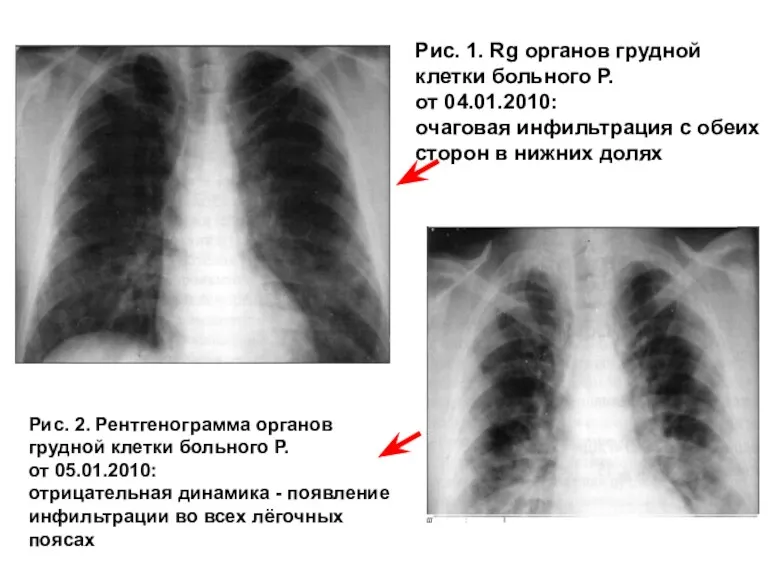 Рис. 1. Rg органов грудной клетки больного Р. от 04.01.2010: