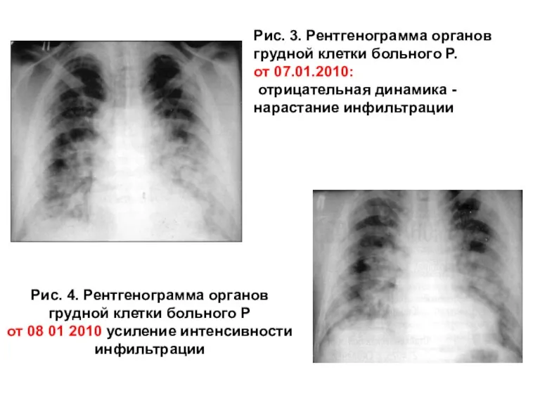 Рис. 3. Рентгенограмма органов грудной клетки больного Р. от 07.01.2010: