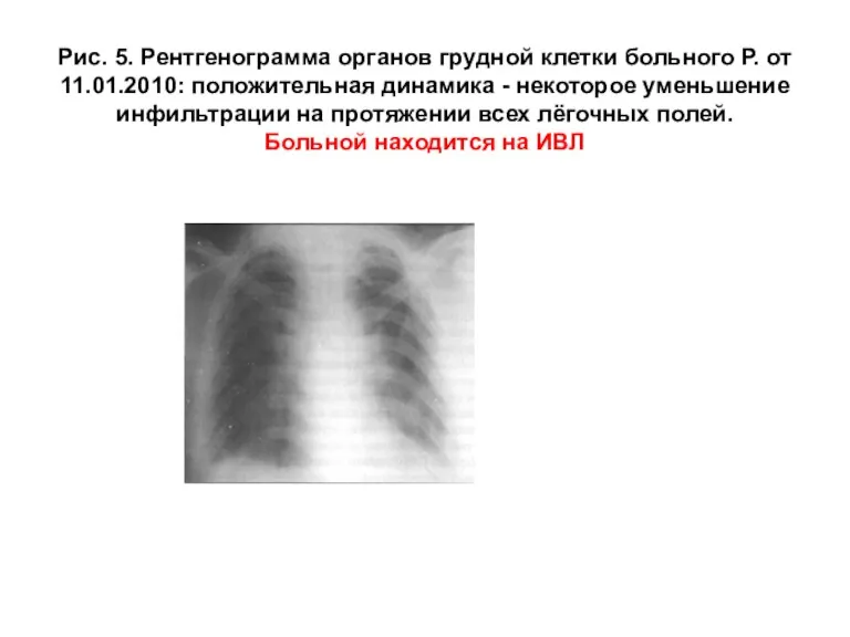 Рис. 5. Рентгенограмма органов грудной клетки больного Р. от 11.01.2010: