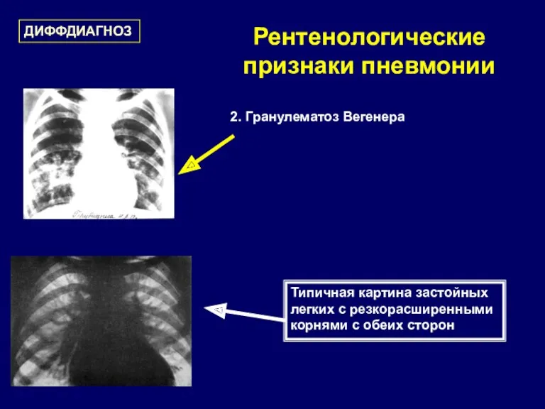 Рентенологические признаки пневмонии Типичная картина застойных легких с резкорасширенными корнями