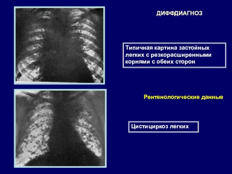 Типичная картина застойных легких с резкорасширенными корнями с обеих сторон Цистициркоз легких Рентенологические данные ДИФФДИАГНОЗ