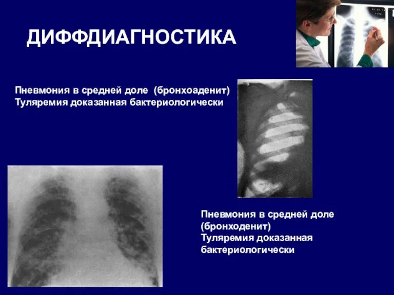 ДИФФДИАГНОСТИКА Пневмония в средней доле (бронхоаденит) Туляремия доказанная бактериологически Пневмония