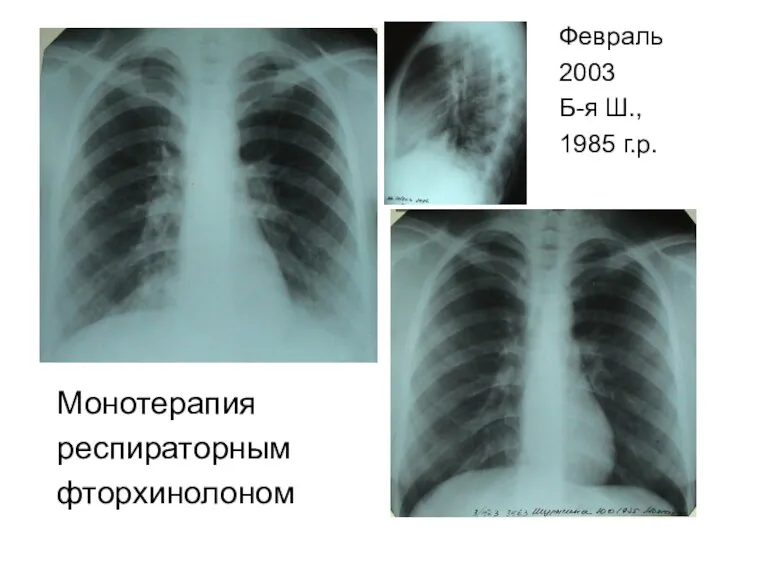 Монотерапия респираторным фторхинолоном Февраль 2003 Б-я Ш., 1985 г.р.