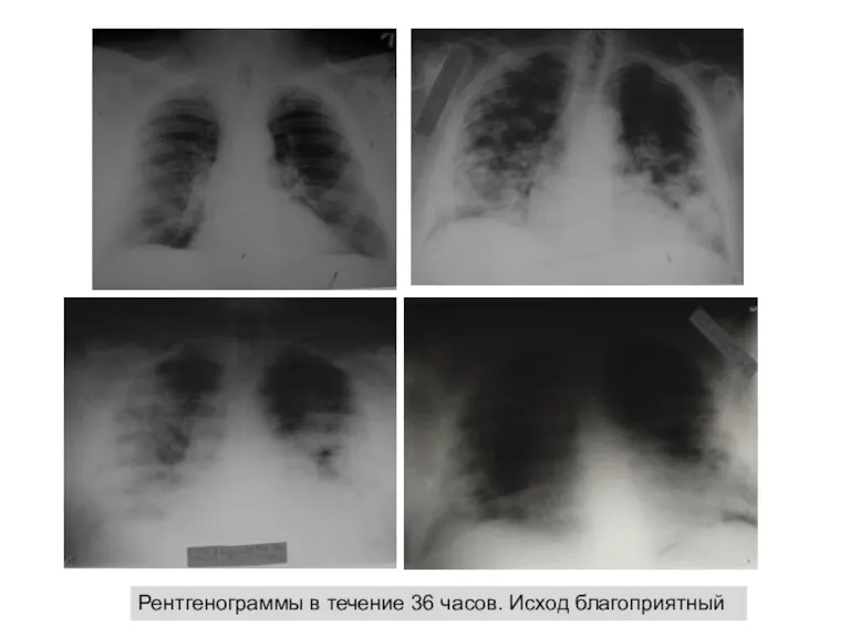 Рентгенограммы в течение 36 часов. Исход благоприятный