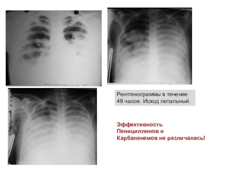 Рентгенограммы в течение 48 часов. Исход летальный. Эффективность Пенициллинов и Карбапенемов не различалась!