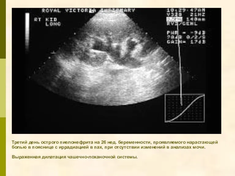 Третий день острого пиелонефрита на 26 нед. беременности, проявляемого нарастающей