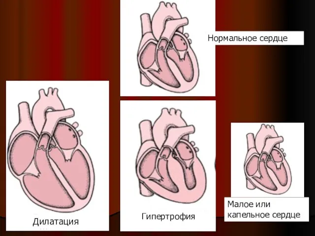 Нормальное сердце Малое или капельное сердце Дилатация Гипертрофия