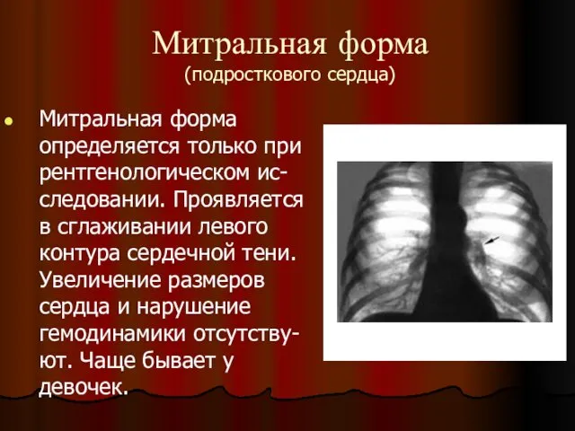 Митральная форма (подросткового сердца) Митральная форма определяется только при рентгенологическом