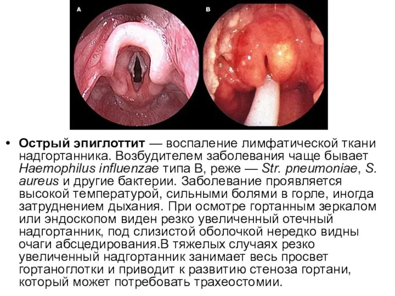 Острый эпиглоттит — воспаление лимфатической ткани надгортанника. Возбудителем заболевания чаще