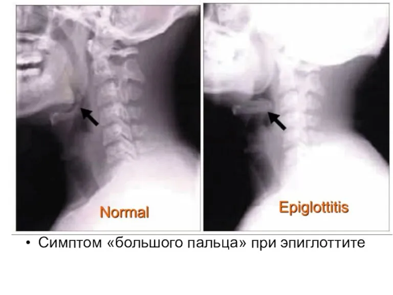 Симптом «большого пальца» при эпиглоттите