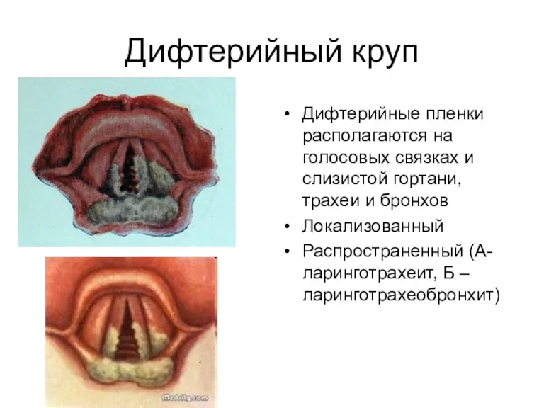 Дифтерийный круп Дифтерийные пленки располагаются на голосовых связках и слизистой