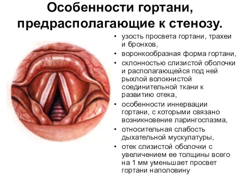 Особенности гортани, предрасполагающие к стенозу. узость просвета гортани, трахеи и