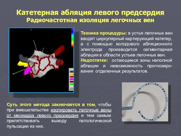 Катетерная абляция левого предсердия Радиочастотная изоляция легочных вен Техника процедуры: