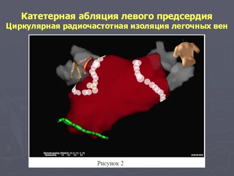 Катетерная абляция левого предсердия Циркулярная радиочастотная изоляция легочных вен