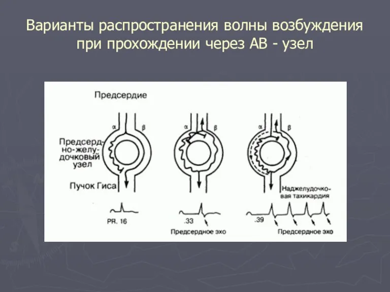 Варианты распространения волны возбуждения при прохождении через АВ - узел