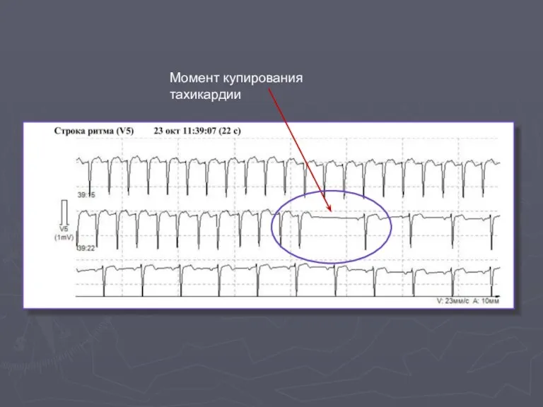 Момент купирования тахикардии