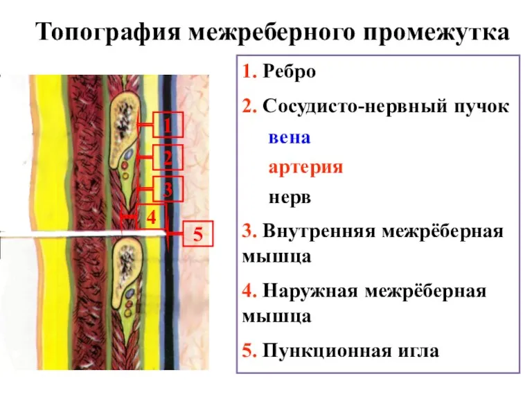 Топография межреберного промежутка 1. Ребро 2. Сосудисто-нервный пучок вена артерия