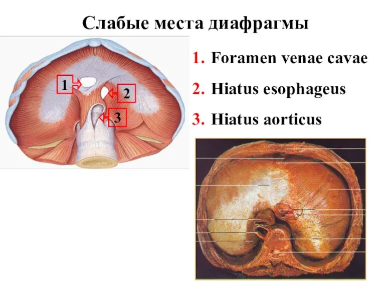 Слабые места диафрагмы 2 1 Foramen venae cavae Hiatus esophageus Hiatus aorticus 3