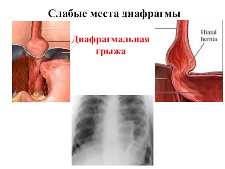 Слабые места диафрагмы Диафрагмальная грыжа