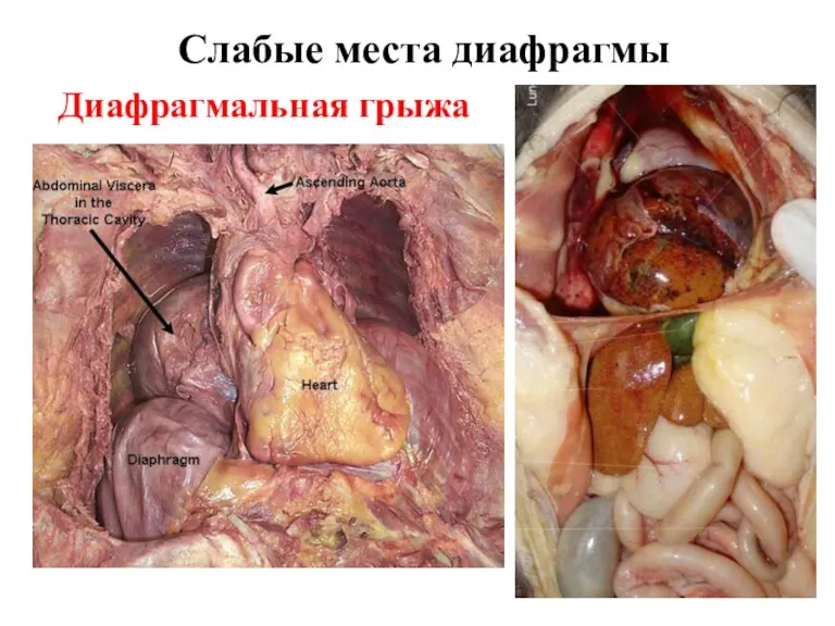 Слабые места диафрагмы Диафрагмальная грыжа