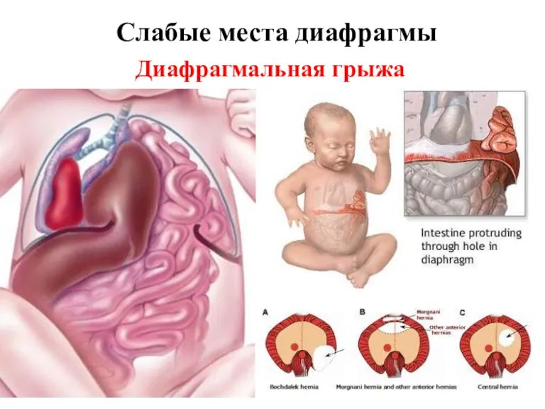 Слабые места диафрагмы Диафрагмальная грыжа