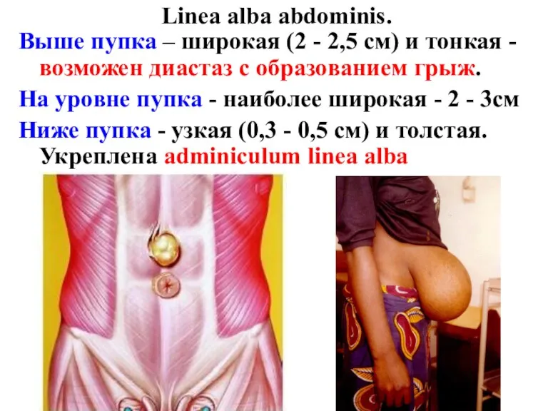 Linea alba abdominis. Выше пупка – широкая (2 - 2,5