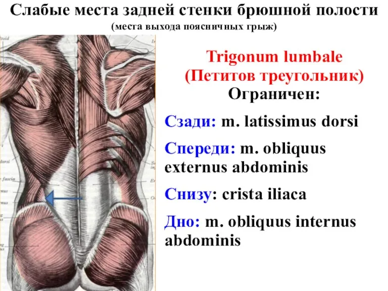 Слабые места задней стенки брюшной полости (места выхода поясничных грыж)