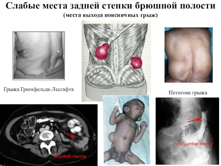 Слабые места задней стенки брюшной полости (места выхода поясничных грыж) Петитова грыжа Грыжа Грюнфельда-Лесгафта