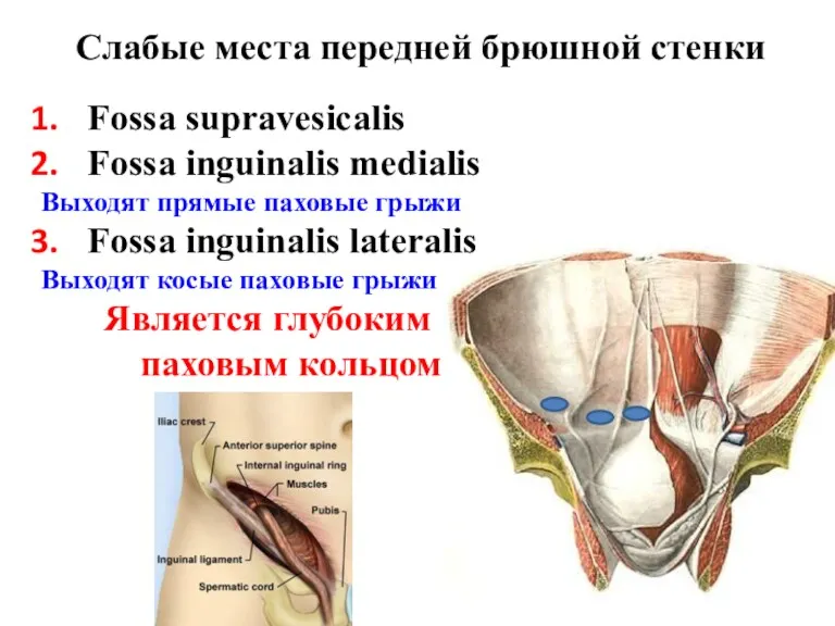 Слабые места передней брюшной стенки Fossa supravesicalis Fossa inguinalis medialis