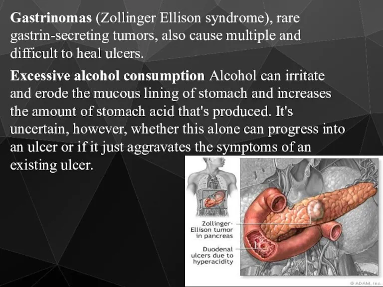 Gastrinomas (Zollinger Ellison syndrome), rare gastrin-secreting tumors, also cause multiple