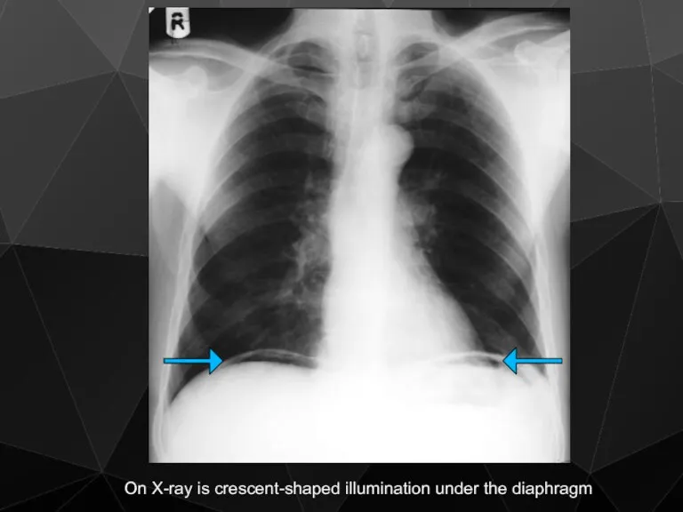 On X-ray is crescent-shaped illumination under the diaphragm