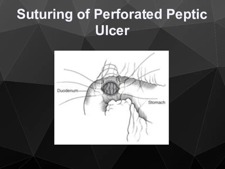 Suturing of Perforated Peptic Ulcer