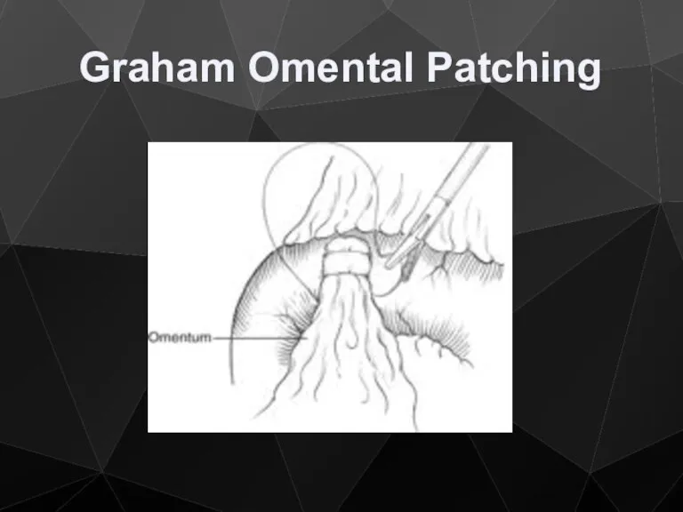 Graham Omental Patching