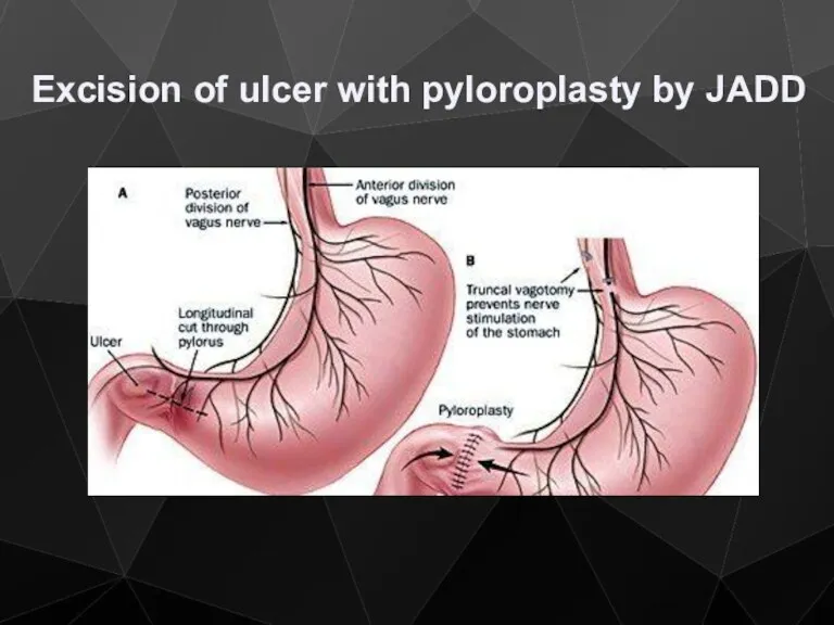 Excision of ulcer with pyloroplasty by JADD