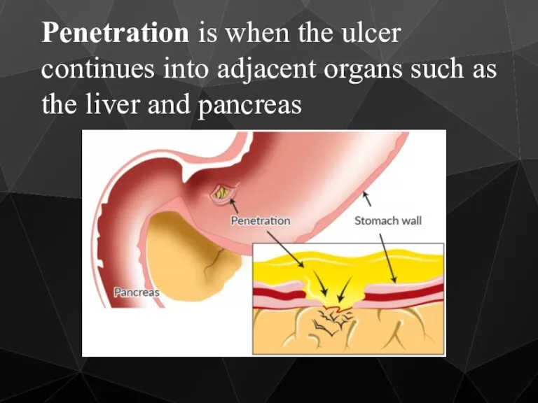 Penetration is when the ulcer continues into adjacent organs such as the liver and pancreas