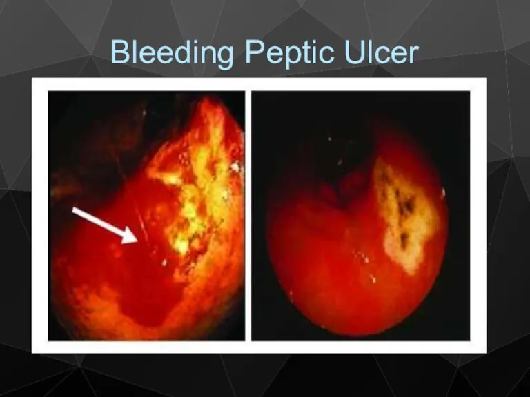 Bleeding Peptic Ulcer