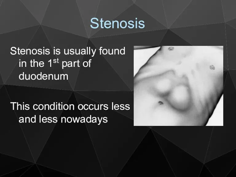 Stenosis Stenosis is usually found in the 1st part of