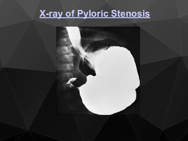 X-ray of Pyloric Stenosis