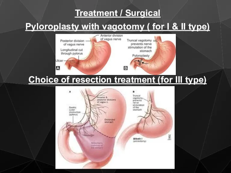 Treatment / Surgical Pyloroplasty with vagotomy ( for I &