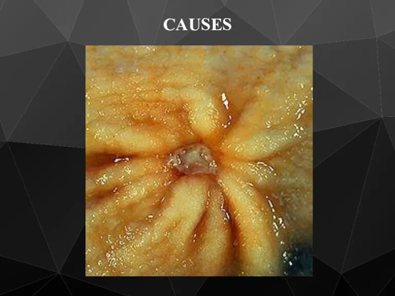 CAUSES