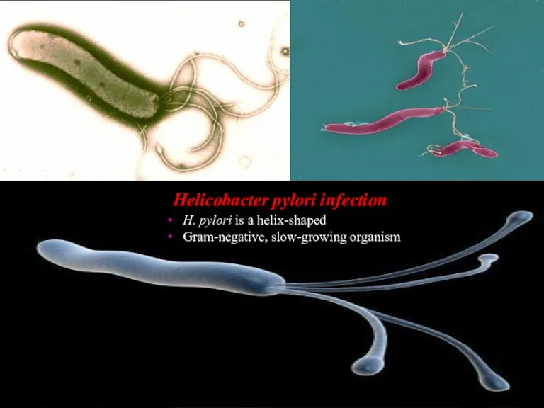 Helicobacter pylori infection H. pylori is a helix-shaped Gram-negative, slow-growing organism