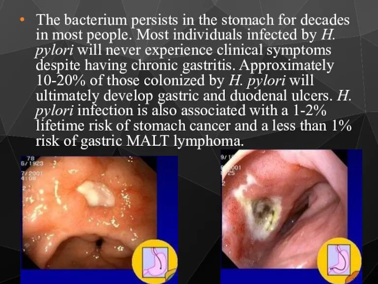 The bacterium persists in the stomach for decades in most