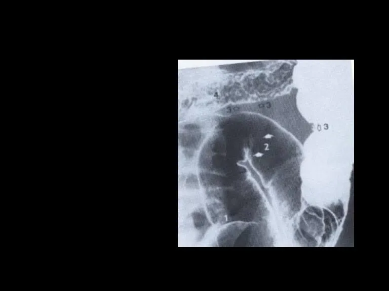 Диагностика болезни Крона (рентгеноскопия) С двойным контрастированием + ирригоскопия. Выявляет: Сегментарность поражения «Булыжная мостовая» «Симптом Шнура»