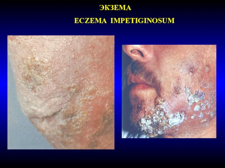 ЭКЗЕМА ECZEMA IMPETIGINOSUM