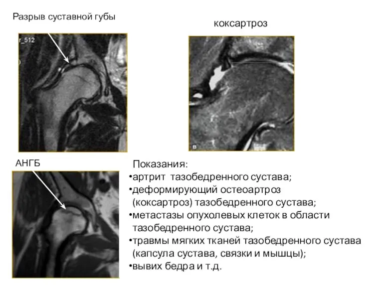 Разрыв суставной губы коксартроз АНГБ Показания: артрит тазобедренного сустава; деформирующий остеоартроз (коксартроз) тазобедренного
