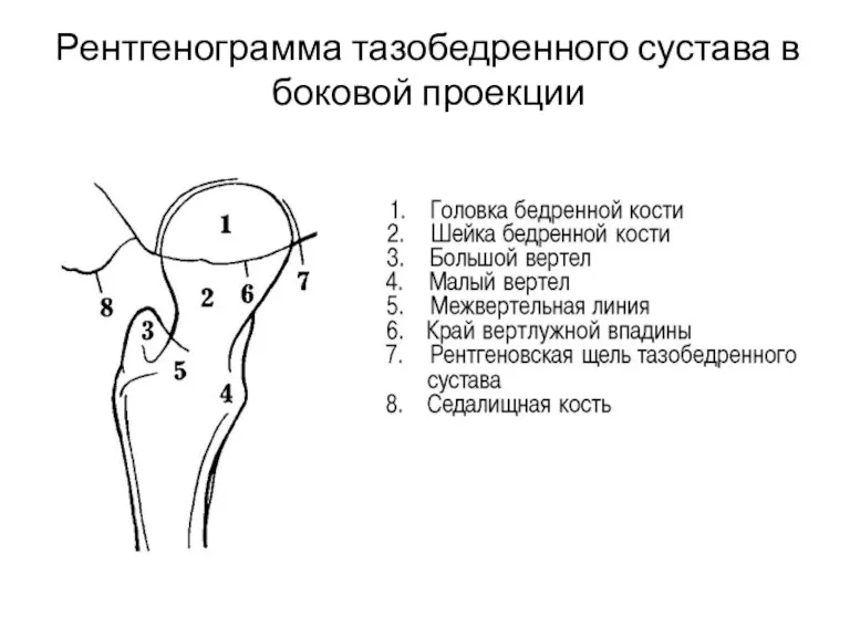 Рентгенограмма тазобедренного сустава в боковой проекции