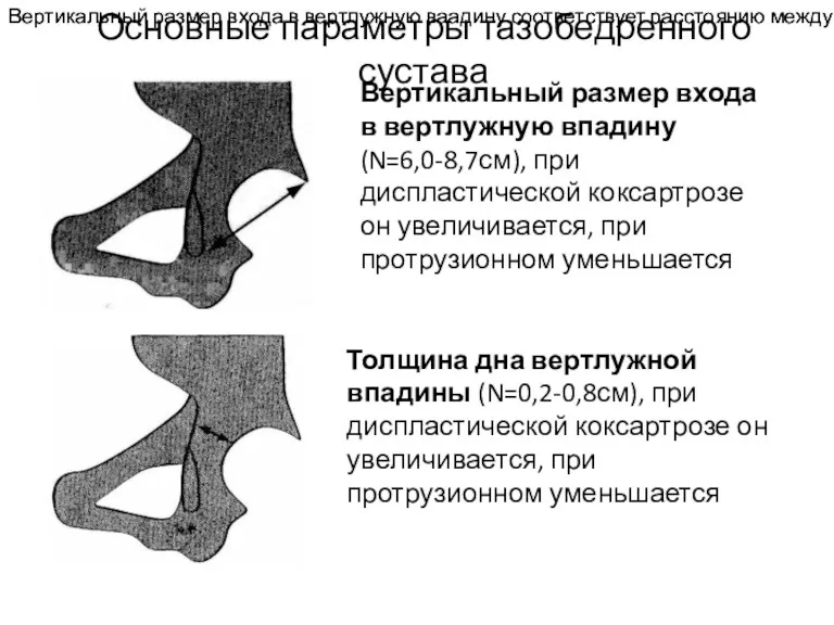 Вертикальный размер входа в вертлужную ваадину соответствует расстоянию между вершиной