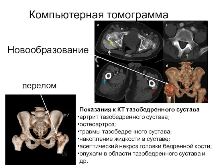 Компьютерная томограмма Показания к КТ тазобедренного сустава артрит тазобедренного сустава; остеоартроз; травмы тазобедренного