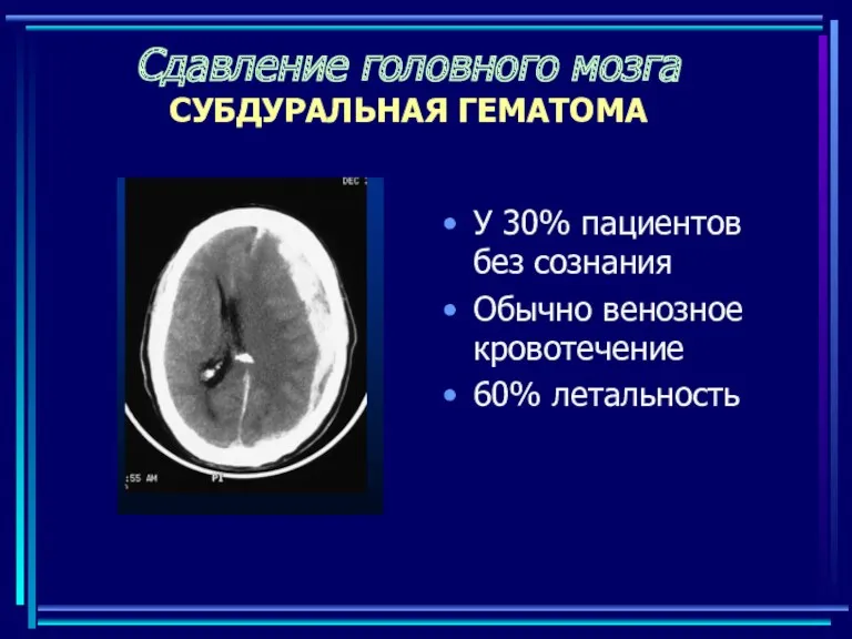 Сдавление головного мозга СУБДУРАЛЬНАЯ ГЕМАТОМА У 30% пациентов без сознания Обычно венозное кровотечение 60% летальность