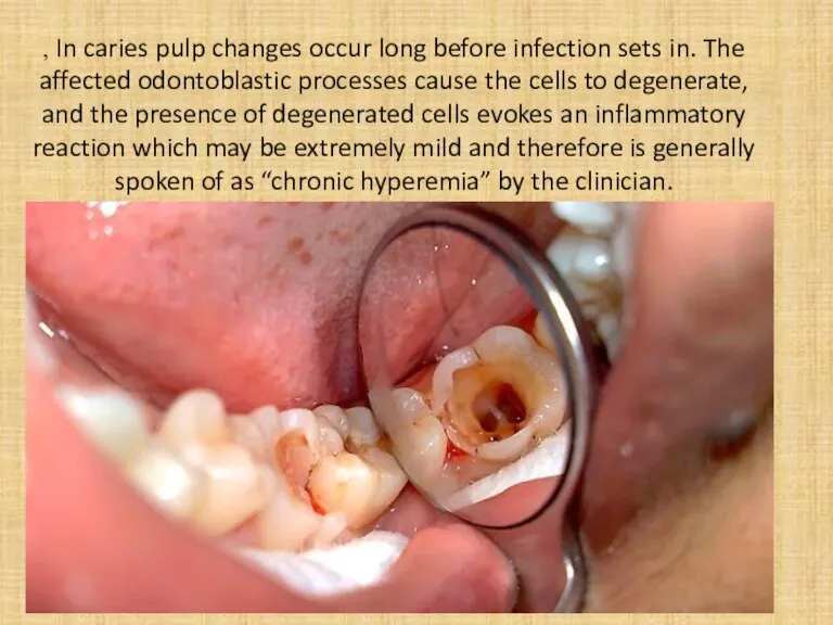 , In caries pulp changes occur long before infection sets in. The affected